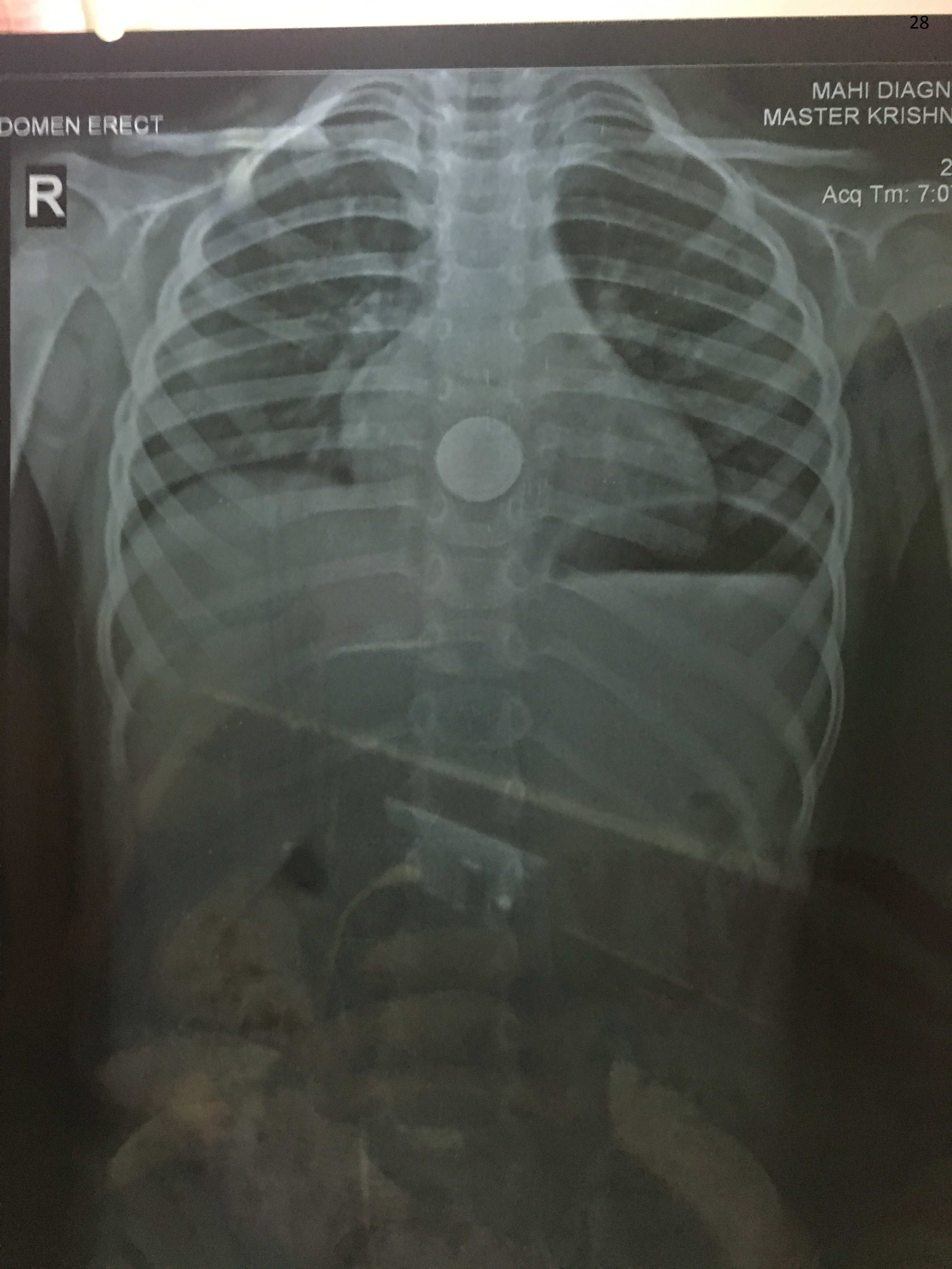 Bronchoscopy Image 4